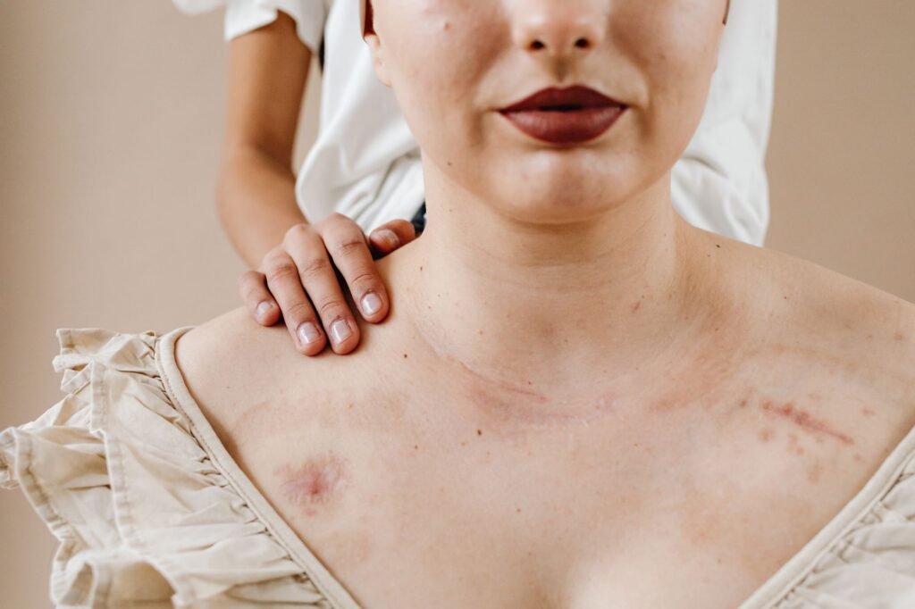A comforting touch on a woman's shoulder displaying scars, symbolizing healing and support.